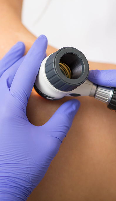 Esame di un neo con il dermatoscopio